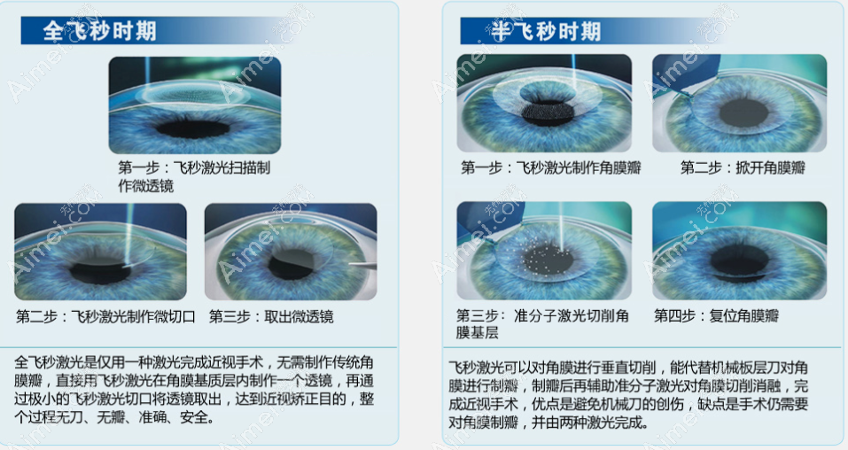 北京爱尔眼科全飞秒和半飞秒手术过程 北京爱尔眼科全飞秒和半飞秒手术过程