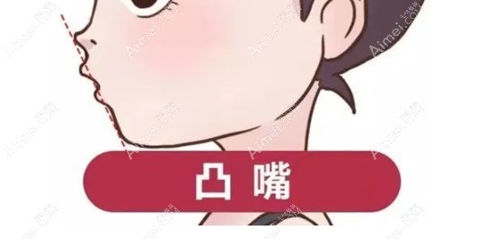 重庆松山医院正颌凸嘴手术价格 重庆松山医院正颌凸嘴手术价格