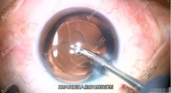 白内障人工晶体安装步骤过程 白内障人工晶体安装步骤过程