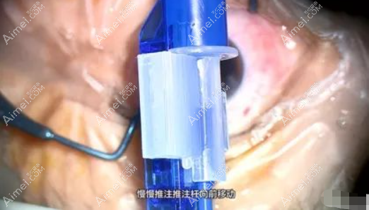 白内障人工晶体安装过程和步骤 白内障人工晶体安装过程和步骤