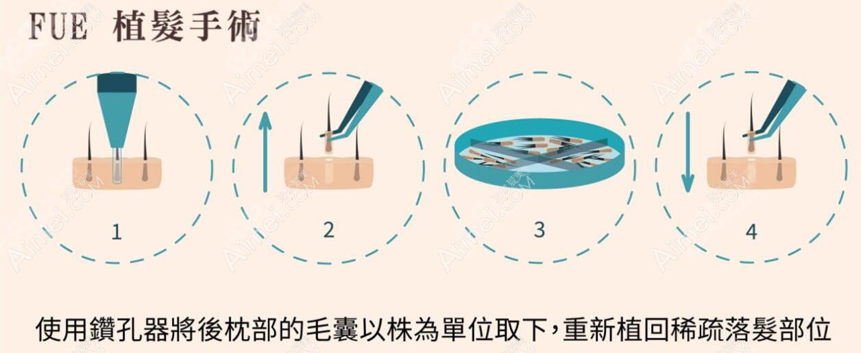 金柯桥医院植发科FUE植发技术 金柯桥医院植发科FUE植发技术