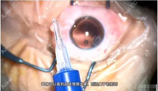 白内障人工晶体安装步骤 白内障人工晶体安装步骤
