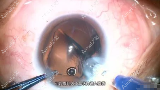 白内障人工晶体安装步骤过程 白内障人工晶体安装步骤过程