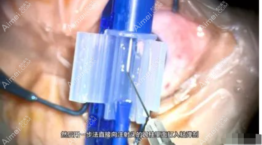 白内障人工晶体安装步骤 白内障人工晶体安装步骤