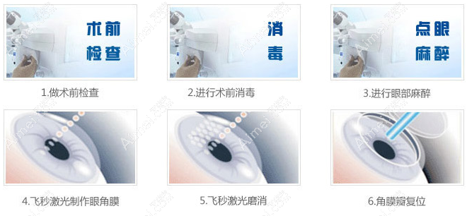 近视600度散光300度做激光近视眼手术优缺点 近视600度散光300度做激光近视眼手术优缺点