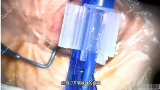 白内障人工晶体安装步骤 白内障人工晶体安装步骤