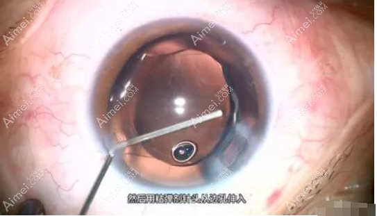 白内障人工晶体安装步骤过程 白内障人工晶体安装步骤过程