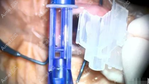 蔡司809m人工晶体安装步骤 蔡司809m人工晶体安装步骤