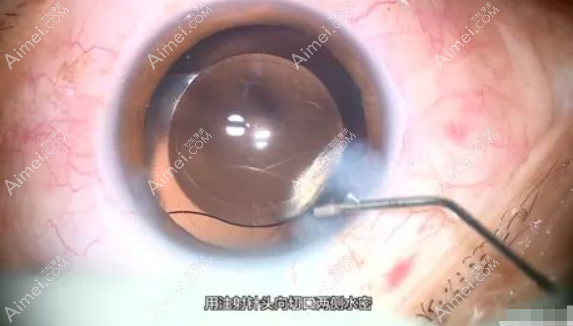 白内障人工晶体安装步骤过程 白内障人工晶体安装步骤过程