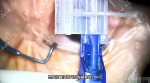 白内障人工晶体安装步骤 白内障人工晶体安装步骤