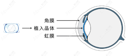 爱尔眼科做icl晶体植入技术好 爱尔眼科做icl晶体植入技术好