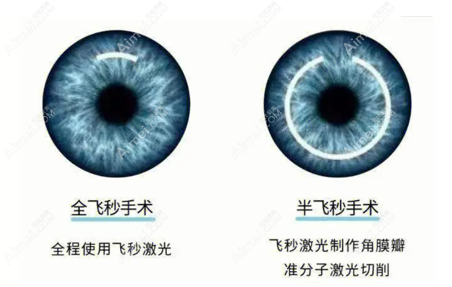 上海半飞秒手术价格 上海半飞秒手术价格