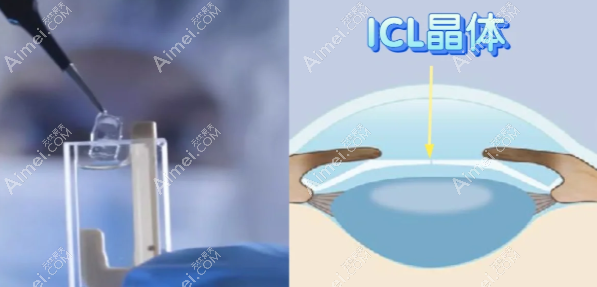 icl晶体植入术有后遗症 icl晶体植入术有后遗症