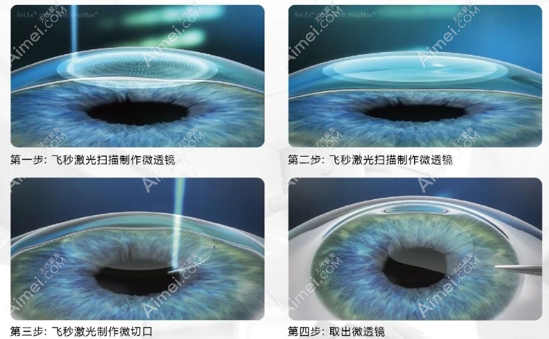 爱尔眼科医院全飞秒激光近视手术价格多少钱 爱尔眼科医院全飞秒激光近视手术价格多少钱