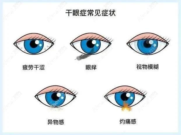 干眼症有哪些症状表现 干眼症有哪些症状表现