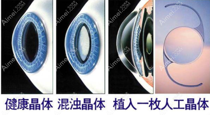 1700、2800、3000、4000、5000、8000、9000人工晶体是个什么水平 1700、2800、3000、4000、5000、8000、9000人工晶体是个什么水平
