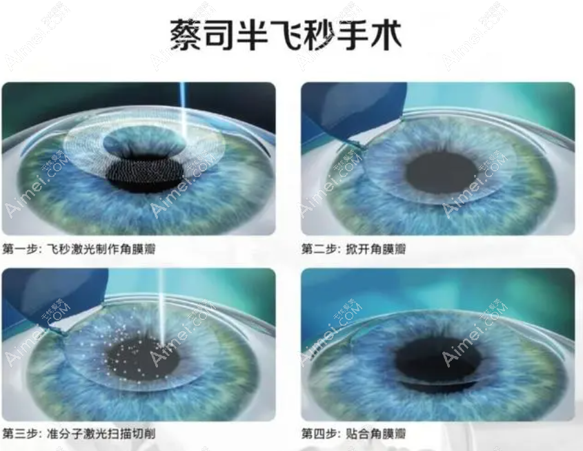 柳州近视飞秒激光手术价格13000元起