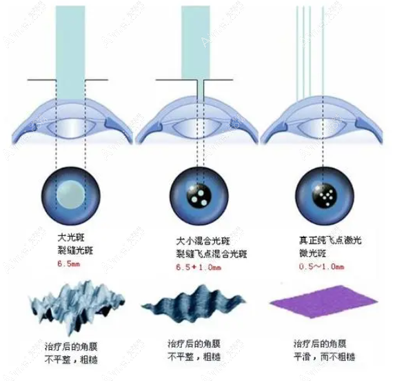 柳州近视眼激光手术价格8800元起