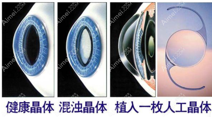 白内障人工晶体植入前后对比图片 白内障人工晶体植入前后对比图片