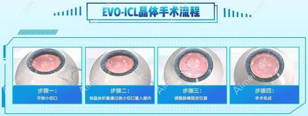 柳州icl晶体植入近视手术价格31000元起aimei.com