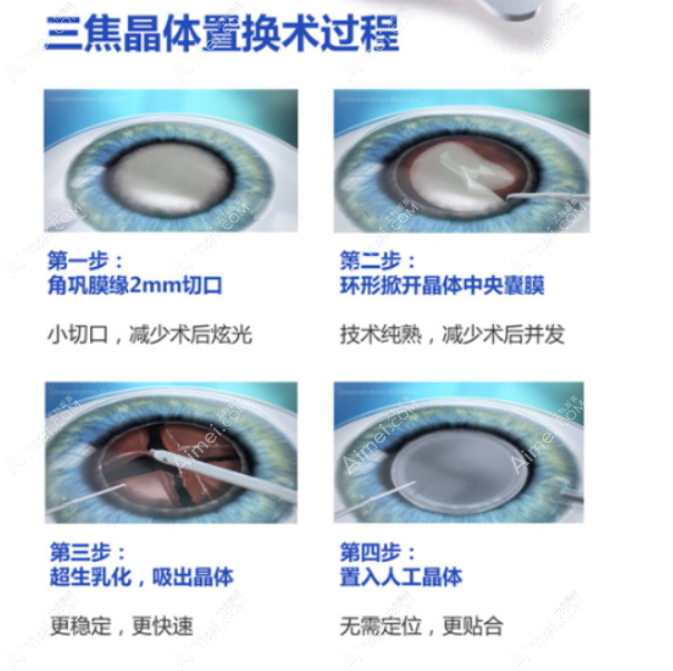 年轻人得了白内障晶体用三焦晶体比较好 年轻人得了白内障晶体用三焦晶体比较好