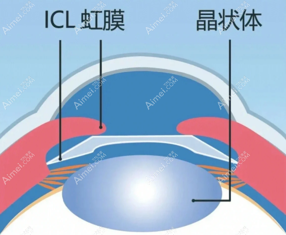 头一批icl晶体植入的人怎么样啦 头一批icl晶体植入的人怎么样啦