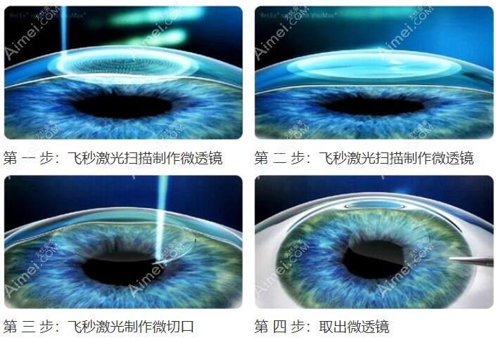 全飞秒近视手术过程dlren.com 全飞秒近视手术过程dlren.com