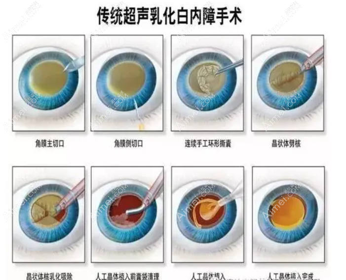 上海年轻人白内障手术费用和方法 上海年轻人白内障手术费用和方法