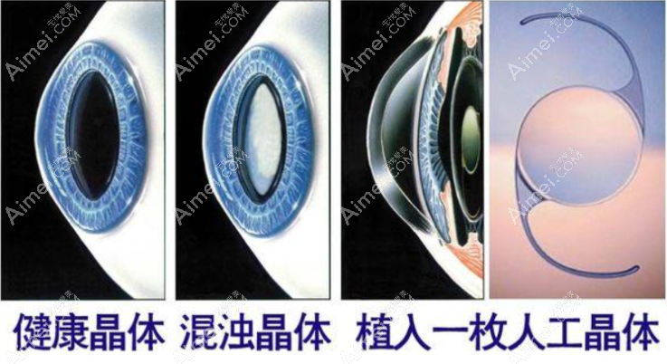 为什么上海老年人做白内障手术价格比年轻人和儿童便宜 为什么上海老年人做白内障手术价格比年轻人和儿童便宜