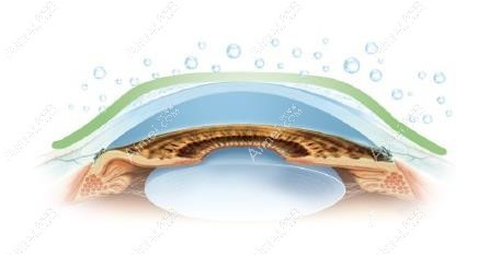 普诺瞳角膜塑形镜原理 普诺瞳角膜塑形镜原理