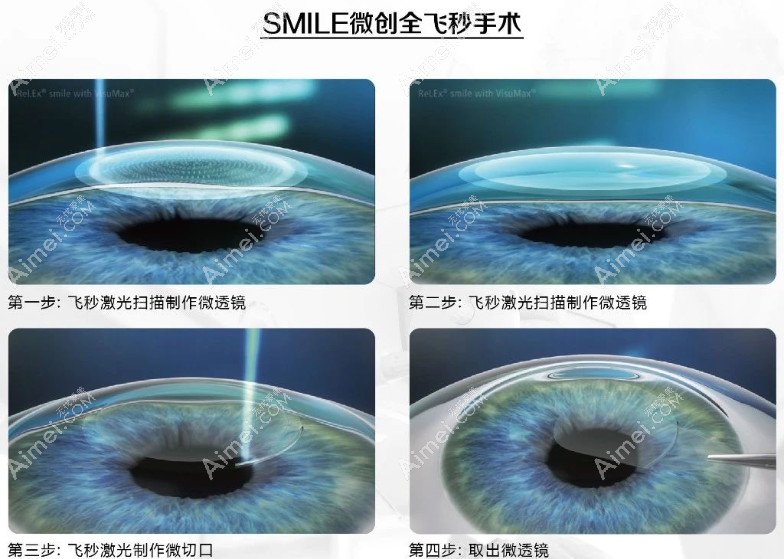55岁近视600度做全飞秒近视手术优缺点
