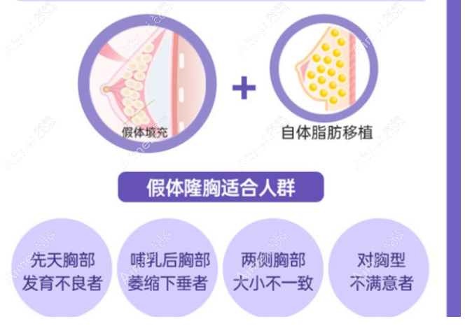 傲诺拉和曼托假体隆胸适合人群 傲诺拉和曼托假体隆胸适合人群