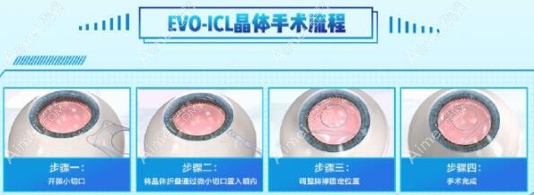 王从毅做ICL晶体植入m.dlren.com