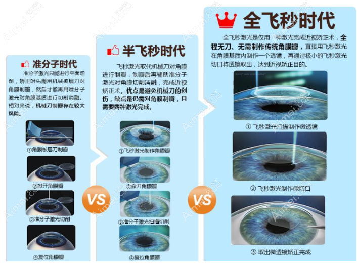 激光近视手术方法有哪些 激光近视手术方法有哪些