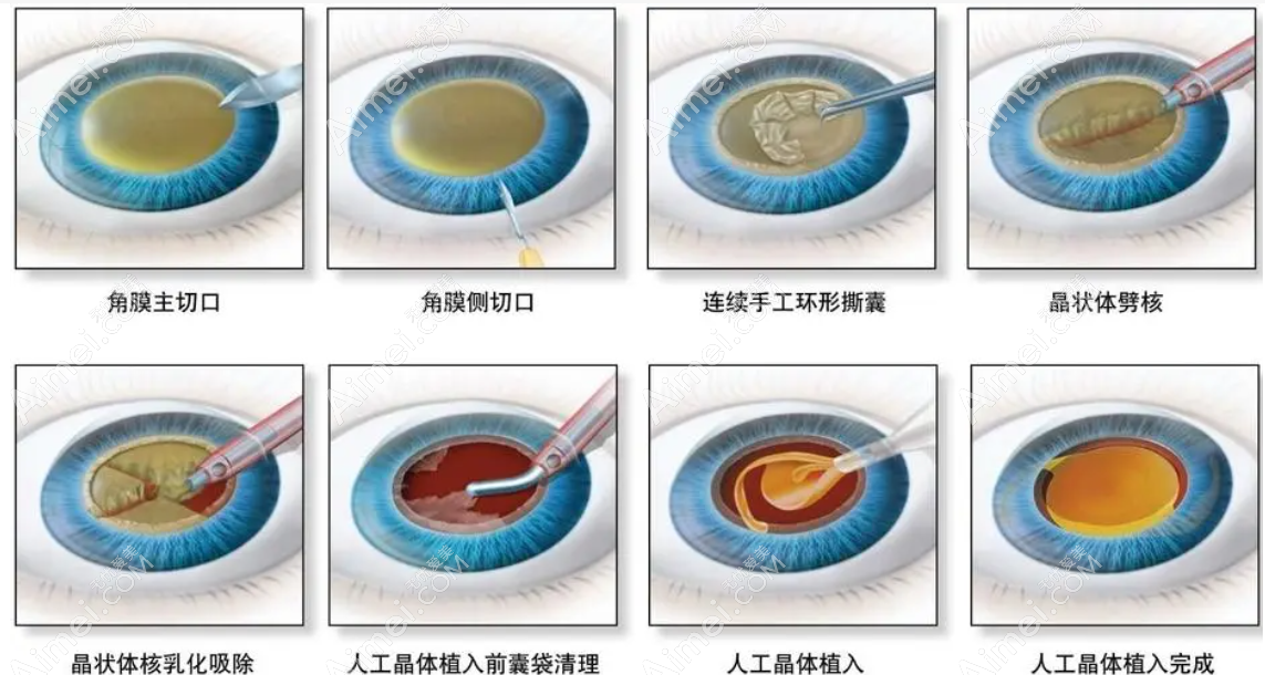 老年人换单焦晶体的缺点 老年人换单焦晶体的缺点