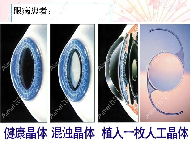白内障晶体换贵点的还是便宜点的好 白内障晶体换贵点的还是便宜点的好