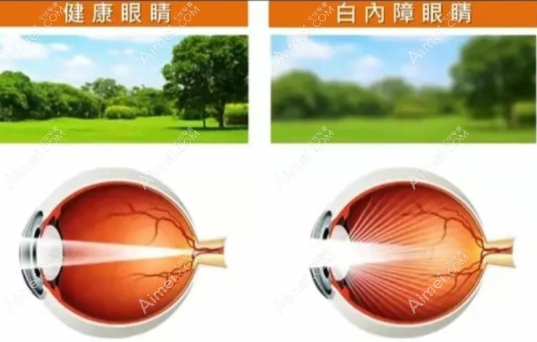 白内障换晶体国产的好还是进口的好?怎么选择看区别及价格