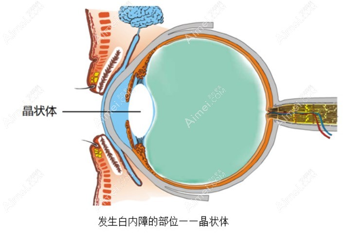 老年人白内障晶体选择 老年人白内障晶体选择