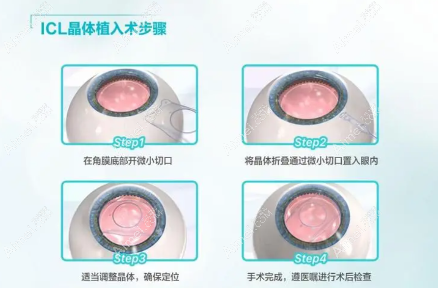 icl晶体植入手术近视眼手术过程和步骤图解 icl晶体植入手术近视眼手术过程和步骤图解
