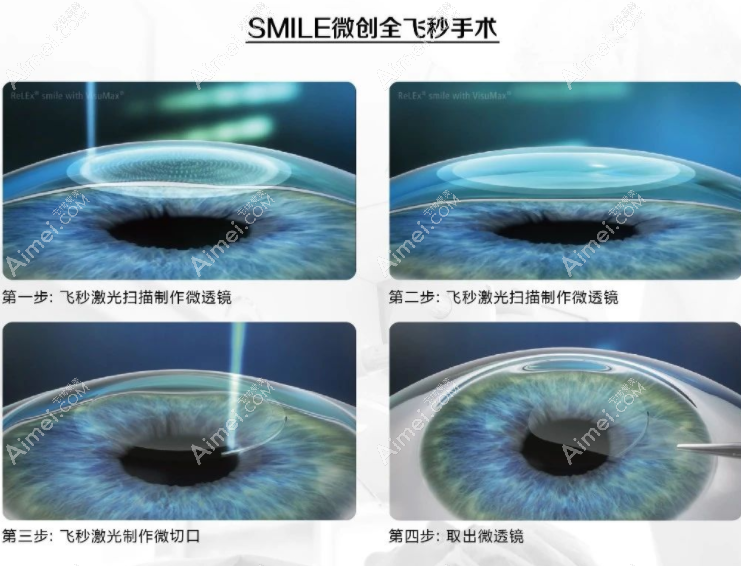 医生做全飞秒激光近视手术后恢复的快 医生做全飞秒激光近视手术后恢复的快