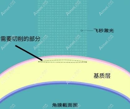 聊城华厦眼科飞秒手术技术图 聊城华厦眼科飞秒手术技术图