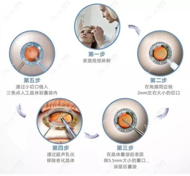 人工晶体能恢复提高多少视力?矫正视力范围是在50-1000度左右