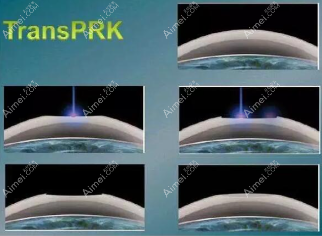 Transprk全激光角膜表层手术过程图解 Transprk全激光角膜表层手术过程图解