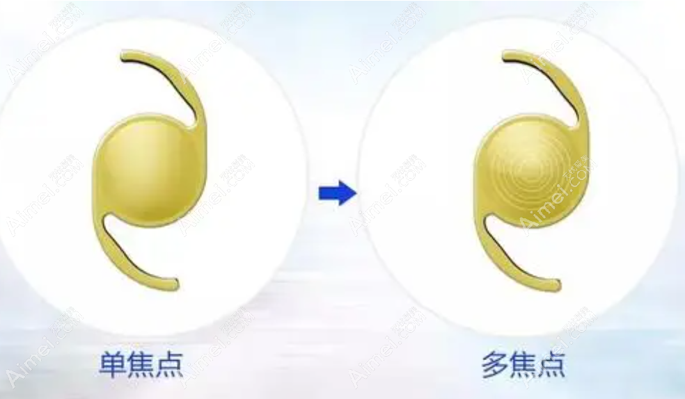 单焦点人工晶体适合2000度近视吗?近视2000度如何治疗看这里