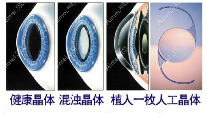 三焦点人工晶体亲身经历和感受 三焦点人工晶体亲身经历和感受