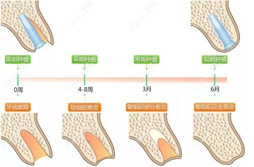 钟科医生擅长即刻种植牙