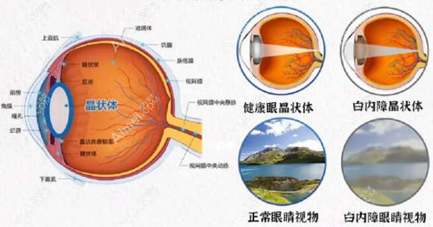 广州白内障手术费用大概多少钱?广州单焦点晶体3000起可报销