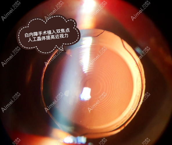 深圳散光型单焦点人工晶体价格dlren.com 深圳散光型单焦点人工晶体价格dlren.com