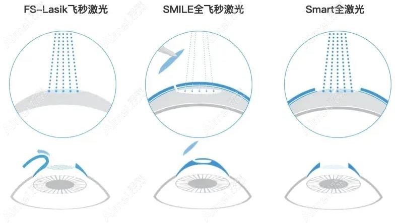 长春近视激光手术不同方式 长春近视激光手术不同方式