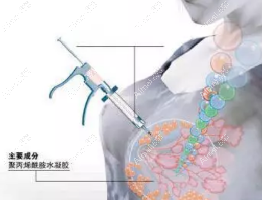黄广香做胸部修复技术好 黄广香做胸部修复技术好